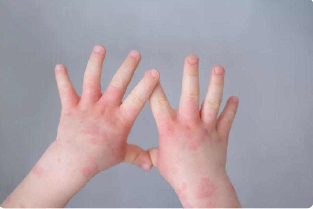 dermatitis atópica en niños